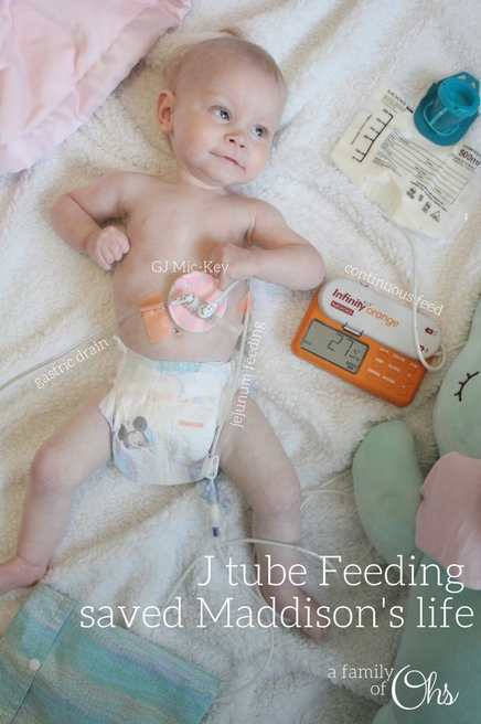 Transitioning To J Tube Feeding A Family Of Ohs